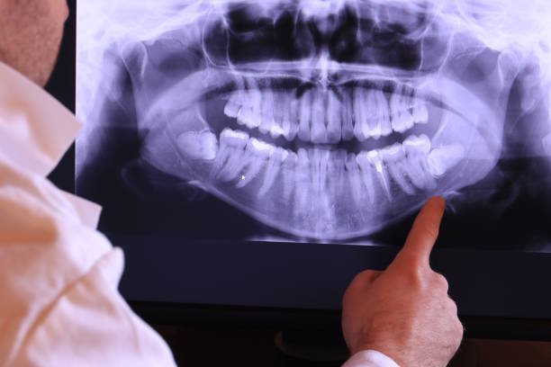 Best Emergency Root Canal Treatment in Kingston, TN