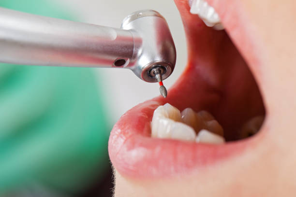 Best Emergency Dentist for Lost Fillings or Crowns in Kingston, TN